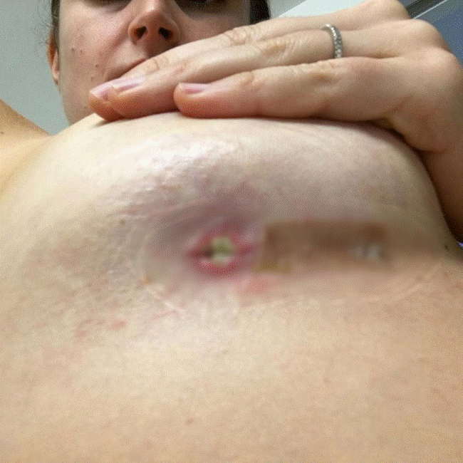 Nâng ngực xong bị phát ra tiếng xì hơi mỗi khi cử động, gái một con sợ xanh mặt vì đặt niềm tin sai chỗ-2