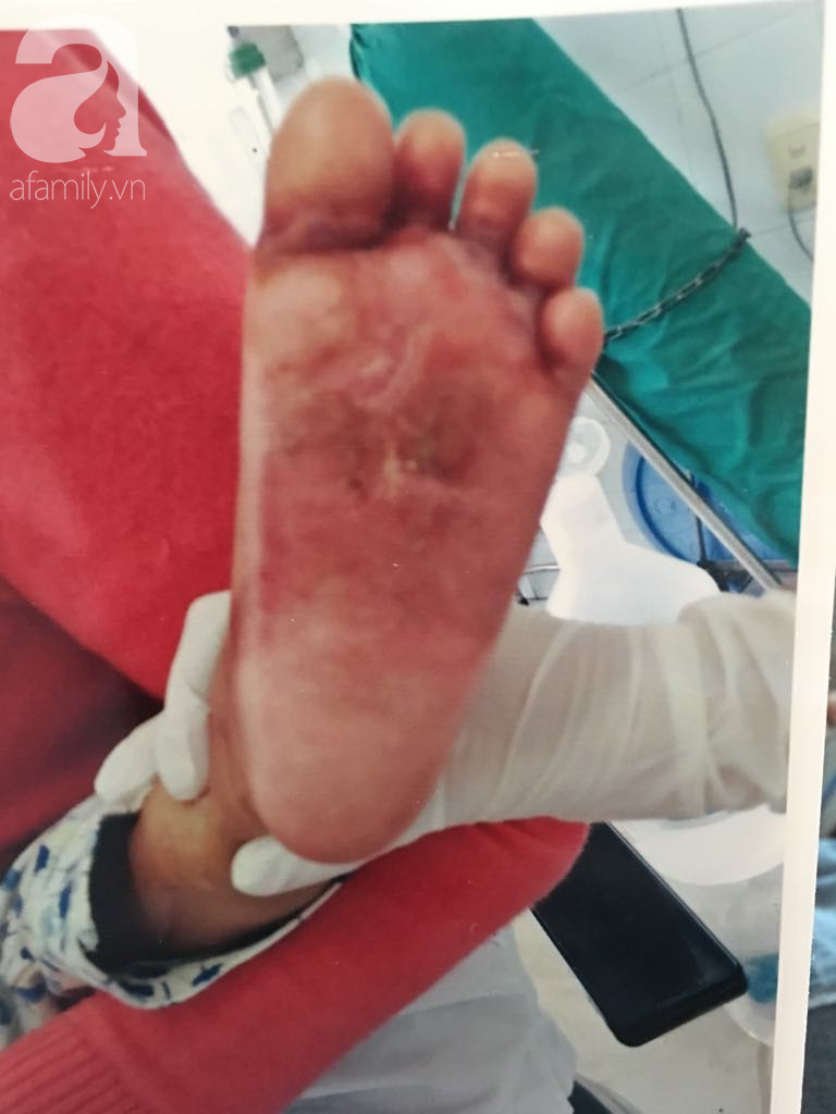 TP.HCM: Bé gái 18 tháng tuổi bị phỏng bất thường ở chân khi đi học ở trường mầm non, bố mẹ làm đơn cầu cứu-2