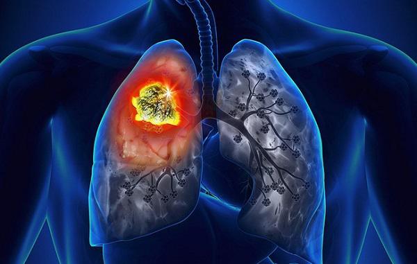 Cậu bé 16 tuổi mắc ung thư, nguyên nhân là do thói quen hàng ngày của ông và bố-1