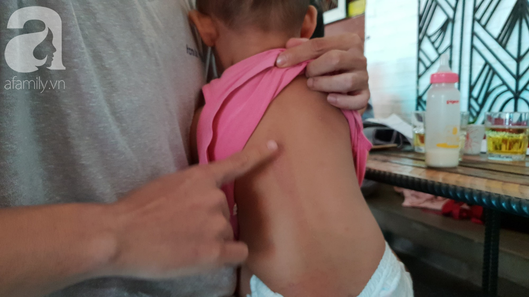 Mẹ bé gái 18 tháng tuổi nghi bị cô giáo tạt nước sôi gây phỏng chân: Đêm nào con bé cũng giật mình khóc ngất-5