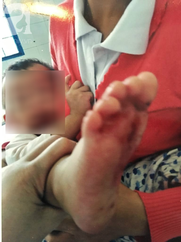 Mẹ bé gái 18 tháng tuổi nghi bị cô giáo tạt nước sôi gây phỏng chân: Đêm nào con bé cũng giật mình khóc ngất-2