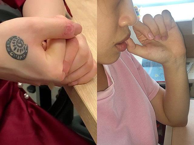 Tự cắt tay, cắn môi đến chảy máu để... tĩnh tâm, BS cảnh báo đây là một dạng tâm thần-1