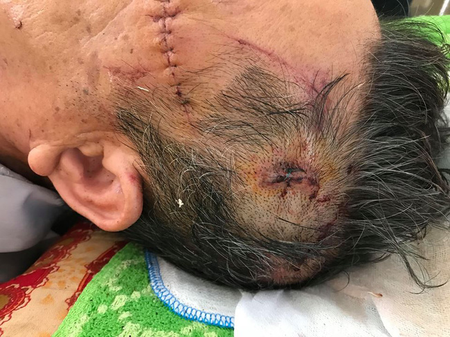 Nạn nhân bị thương trong vụ trộm sát hại nữ chủ nhà ở Hưng Yên kể lại giây phút sinh tử-5