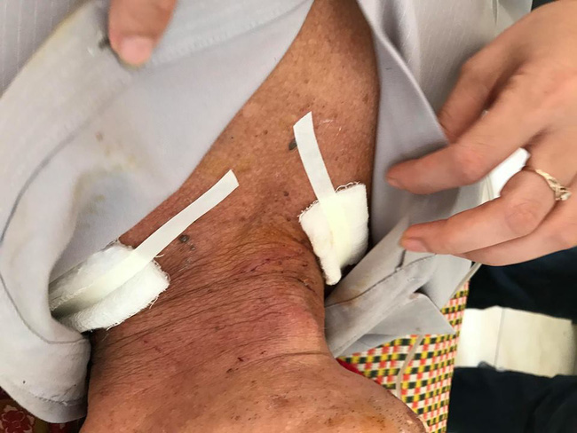 Nạn nhân bị thương trong vụ trộm sát hại nữ chủ nhà ở Hưng Yên kể lại giây phút sinh tử-4