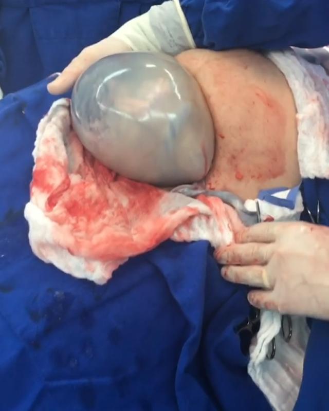 Khoảnh khắc lạ lùng: Em bé chui đầu ra khỏi bụng mẹ nhưng bọc ối vẫn còn nguyên-1