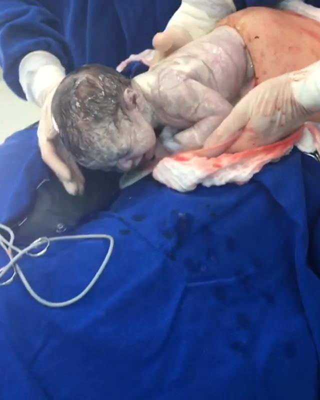 Khoảnh khắc lạ lùng: Em bé chui đầu ra khỏi bụng mẹ nhưng bọc ối vẫn còn nguyên-2