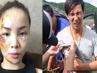 Sao Việt và những lần gặp tai nạn nghiêm trọng: Gãy xương, suy giảm thị lực nhưng vẫn chưa phải điều kinh khủng nhất