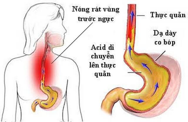 Chuyên gia Tiêu hóa BV Bạch Mai chia sẻ tư thế ngủ tốt cho dạ dày, tránh trào ngược-1