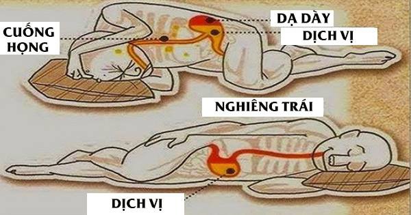 Chuyên gia Tiêu hóa BV Bạch Mai chia sẻ tư thế ngủ tốt cho dạ dày, tránh trào ngược-2