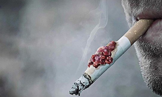 Nam thiếu niên 15 tuổi bị ung thư phổi nghi hút thuốc lá thụ động từ bố-2