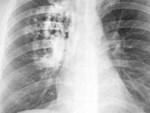 Hơn 20.000 người Việt tử vong do ung thư phổi mỗi năm: Phát hiện bệnh sớm để sống lâu hơn-3