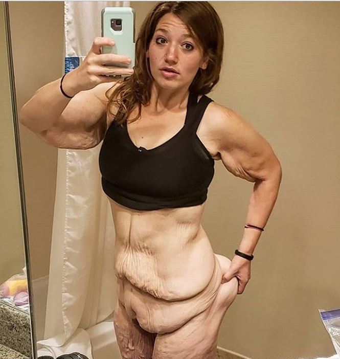 Cơ thể gây ám ảnh của cô gái giảm 141kg trong hơn 1 năm-1