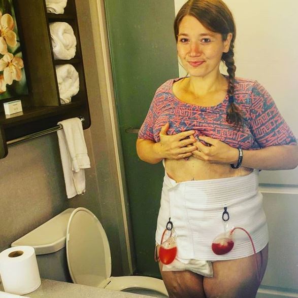 Cơ thể gây ám ảnh của cô gái giảm 141kg trong hơn 1 năm-5