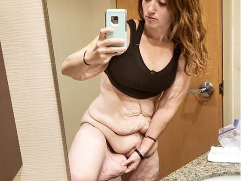 Cơ thể gây ám ảnh của cô gái giảm 141kg trong hơn 1 năm