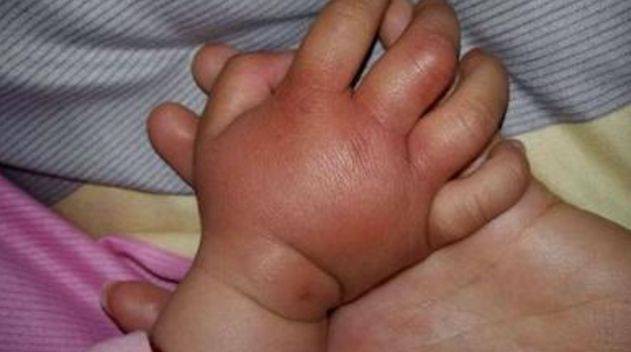 Bàn tay bé 5 tháng tuổi sưng phồng như bánh bao, bố ân hận khi bác sĩ tiết lộ kết quả chụp X-quang-1