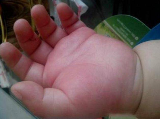 Bàn tay bé 5 tháng tuổi sưng phồng như bánh bao, bố ân hận khi bác sĩ tiết lộ kết quả chụp X-quang-2