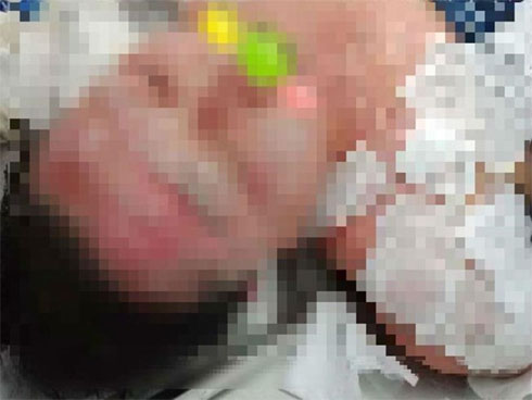 Sự thật về người phụ nữ bỏng nặng do làm đẹp bằng cồn nhân sâm-1