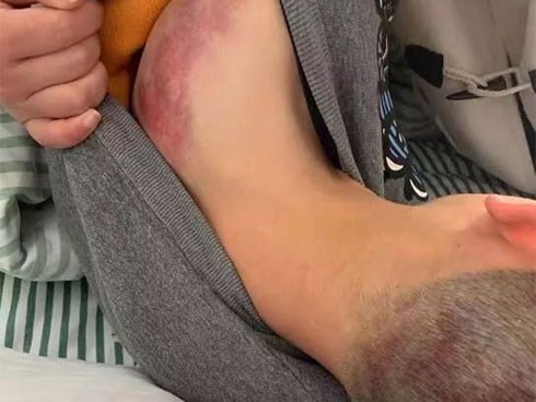 Đi trễ 2 phút, cậu bé bị giáo viên đánh bằng 4 cây chổi, nhìn ảnh thương tích cư dân mạng tức giận phán 