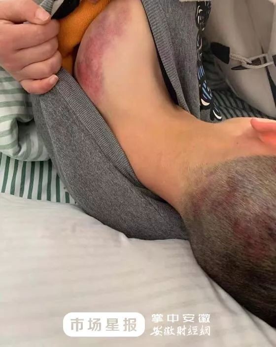 Đi trễ 2 phút, cậu bé bị giáo viên đánh bằng 4 cây chổi, nhìn ảnh thương tích cư dân mạng tức giận phán không phải con người-3