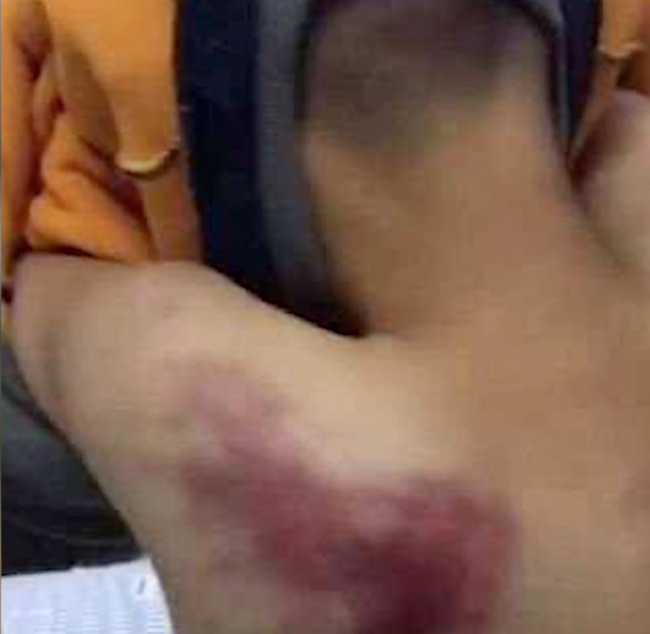 Đi trễ 2 phút, cậu bé bị giáo viên đánh bằng 4 cây chổi, nhìn ảnh thương tích cư dân mạng tức giận phán không phải con người-4