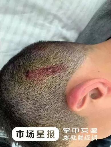 Đi trễ 2 phút, cậu bé bị giáo viên đánh bằng 4 cây chổi, nhìn ảnh thương tích cư dân mạng tức giận phán không phải con người-2