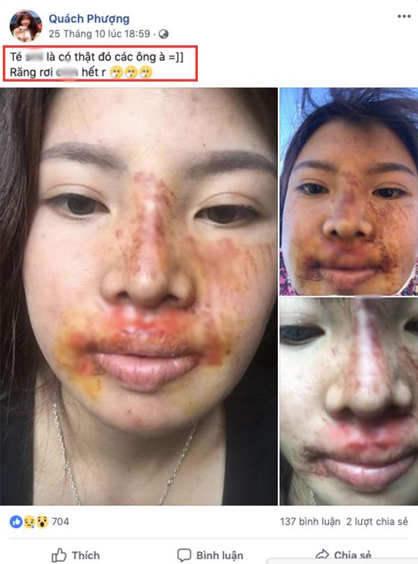 Bị chê xuống sắc hậu dao kéo, Phượng Thị Nở khoe ảnh nhan sắc thay đổi chóng mặt-5