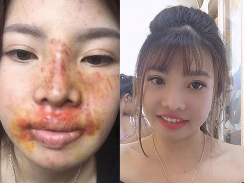 Bị chê xuống sắc hậu dao kéo, Phượng 
