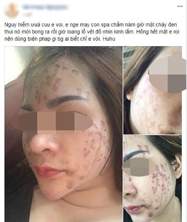 Chấm nám bằng axit: Phương pháp khiến chị em đang xinh đẹp trở thành thảm họa xấu xí-1