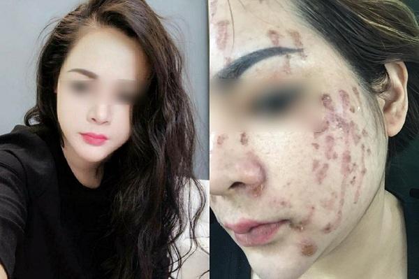 Chấm nám bằng axit: Phương pháp khiến chị em đang xinh đẹp trở thành thảm họa xấu xí-2