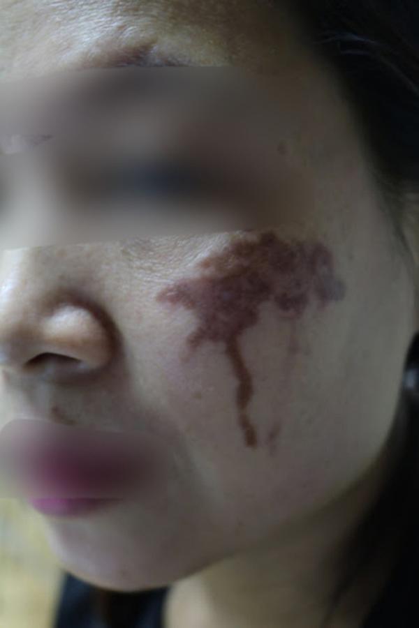 Chấm nám bằng axit: Phương pháp khiến chị em đang xinh đẹp trở thành thảm họa xấu xí-4