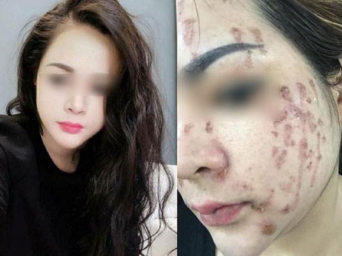 Chấm nám bằng axit: Phương pháp khiến chị em đang xinh đẹp trở thành thảm họa xấu xí