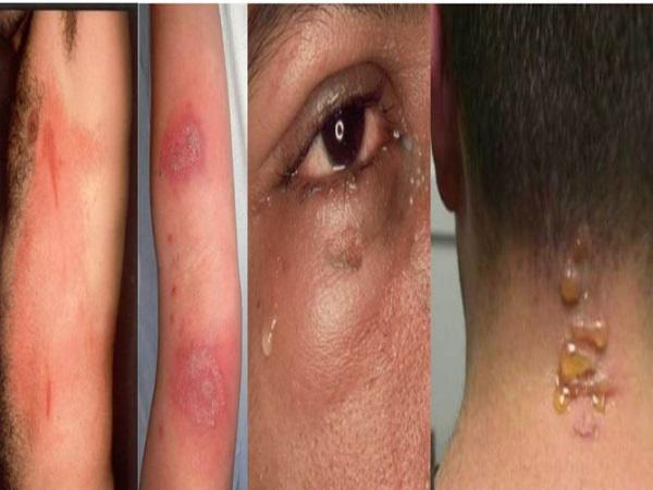 Hàng chục người nhập viện mỗi ngày vì kiến ba khoang: Nguyên nhân đều bắt nguồn từ một sai lầm-1