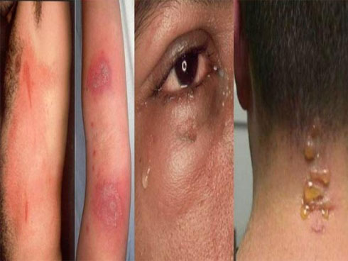 Kiến ba khoang hoành hành, nhiều người nhầm với zona: Làm sao phân biệt để không gây biến chứng?-3