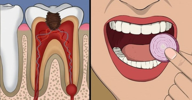 11 cách giúp bạn dịu cơn đau do mọc răng khôn-11