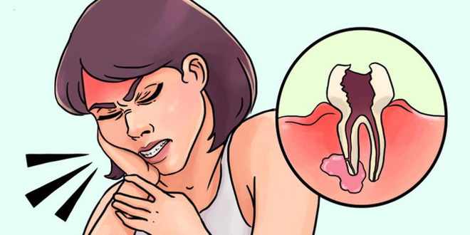11 cách giúp bạn dịu cơn đau do mọc răng khôn-5