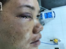 Đang đứng trước cửa nhà, người phụ nữ 32 tuổi bị viên đạn ghim thẳng vào mắt, suýt mù vĩnh viễn Đang đứng trước cửa nhà, người phụ nữ 32 tuổi bị viên đạn ghim thẳng vào mắt, suýt mù vĩnh viễn