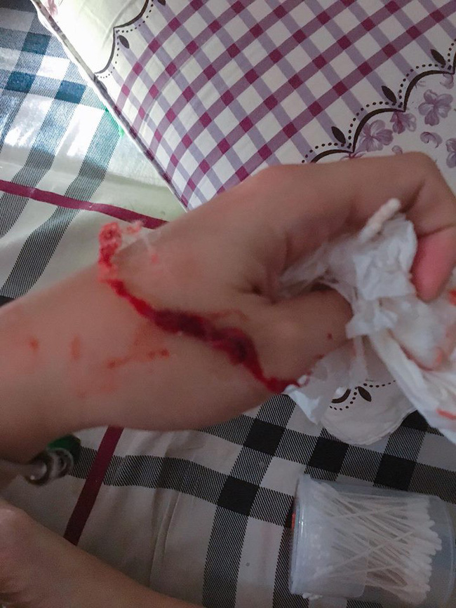 Con chảy mủ hôi tanh cả tháng không khỏi, mẹ phát hoảng khi gắp được dị vật thân quen trong mũi của con-2