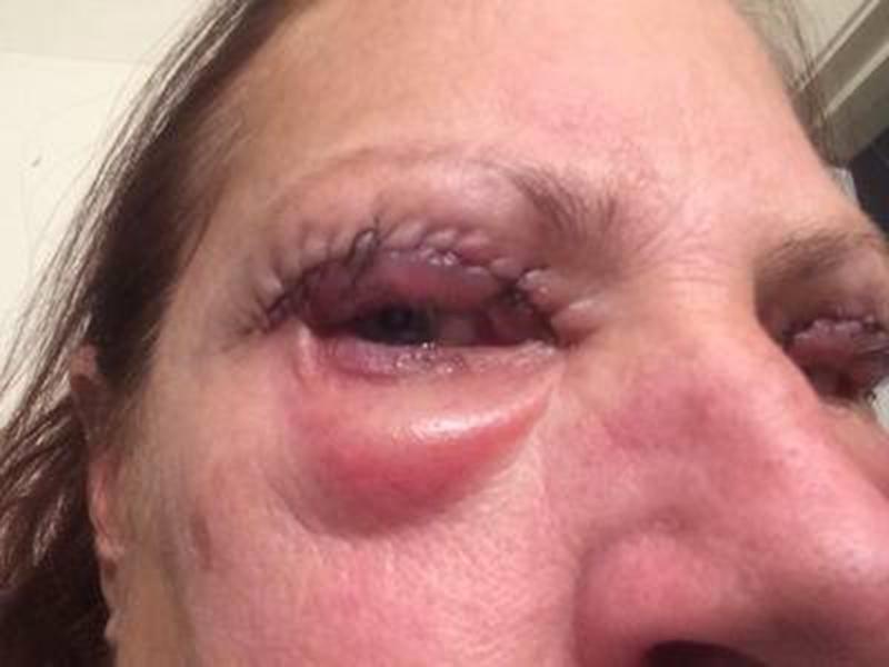 Nhìn những hình ảnh kinh hoàng này, chị em có cân nhắc lại về quyết định cắt mí mắt không?-11