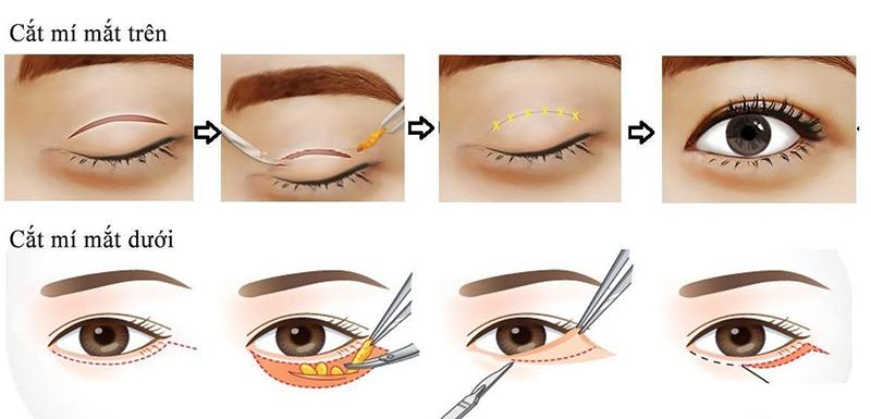 Nhìn những hình ảnh kinh hoàng này, chị em có cân nhắc lại về quyết định cắt mí mắt không?-2