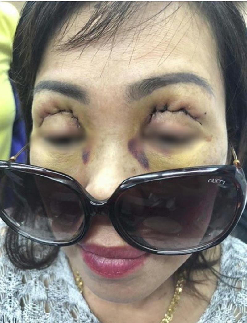 Hình ảnh bệnh đau mắt đỏ qua các giai đoạn - Nhà thuốc FPT Long Châu