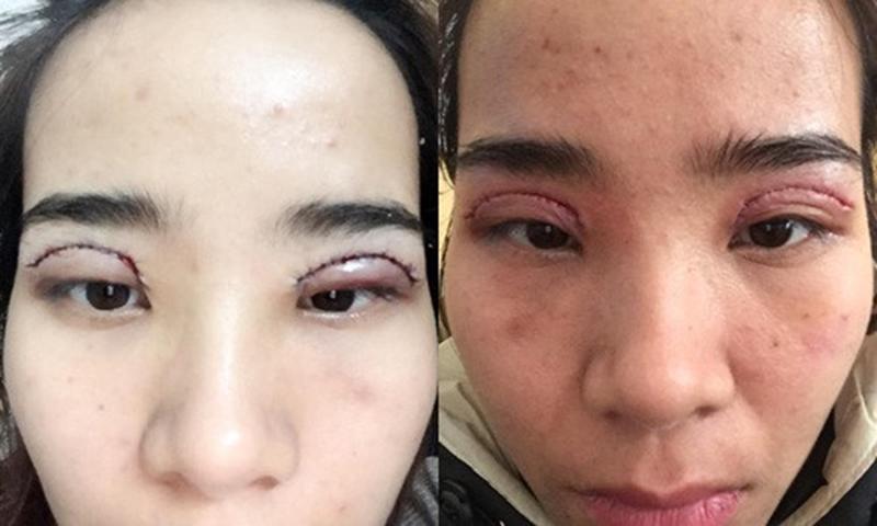 Nhìn những hình ảnh kinh hoàng này, chị em có cân nhắc lại về quyết định cắt mí mắt không?-4
