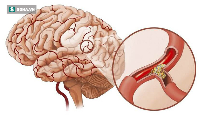 BS cảnh báo: 4 dấu hiệu cho thấy mạch máu đang dần bị tắc, xử lý ngay để tránh nguy hiểm-2