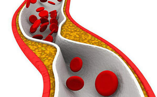 BS cảnh báo: 4 dấu hiệu cho thấy mạch máu đang dần bị tắc, xử lý ngay để tránh nguy hiểm-3
