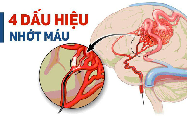BS cảnh báo: 4 dấu hiệu cho thấy mạch máu đang dần bị tắc, xử lý ngay để tránh nguy hiểm-1