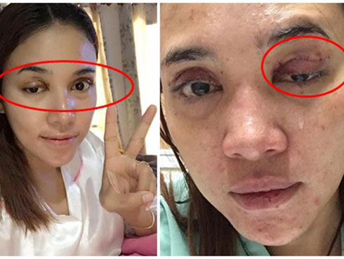 CẮT MÍ BỊ ĐỨT CƠ NÂNG MI GÂY SỤP MÍ CẦN CAN THIỆP ĐIỀU TRỊ GẤP