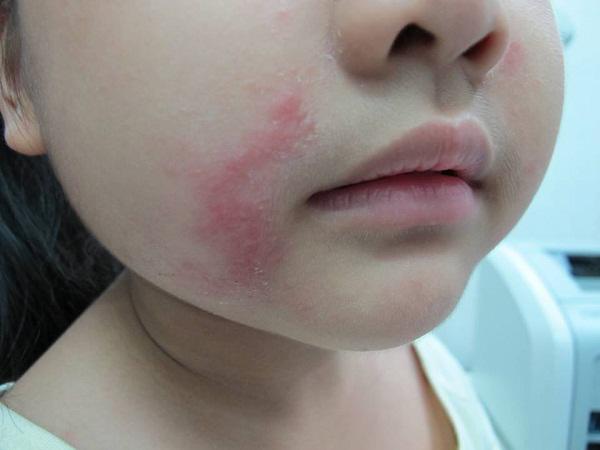 Kiến ba khoang hoành hành, nhiều người nhầm với zona: Làm sao phân biệt để không gây biến chứng?-1