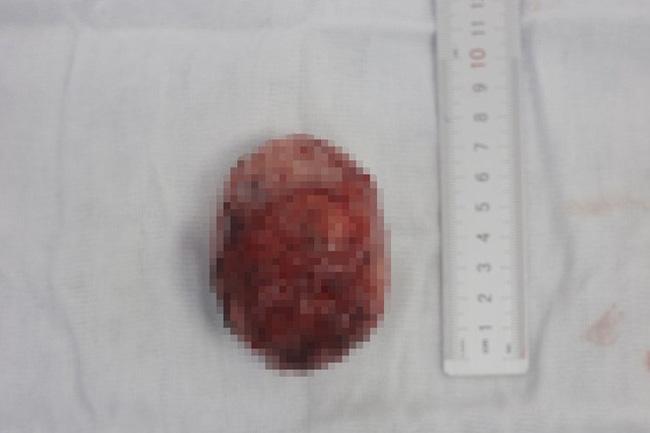 42 tuổi bất ngờ mang thai sau 18 năm, mẹ Nghệ An hốt hoảng nhận tin dữ-3