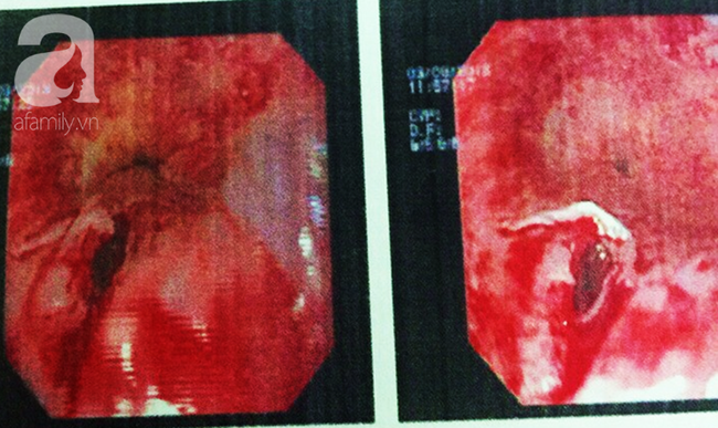 Nhiều trường hợp ngưng tim, ngưng thở vì ăn bún: Hãy ghi nhớ điều này khi dùng bữa nếu không muốn mất mạng-7
