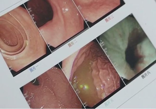 Cảnh báo chảy máu dạ dày bởi món ăn vặt phổ biến mùa lạnh-3