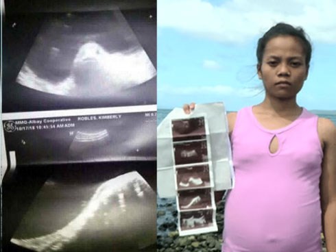 Ảnh siêu âm cùng chiếc bụng lớn dần khiến cả làng tin rằng thiếu nữ đã mang thai với cá, sự thật sau đó làm mọi người ngã ngửa